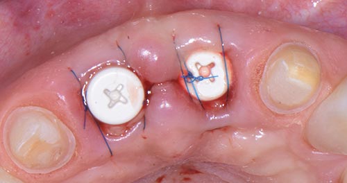 Impianto in zirconia