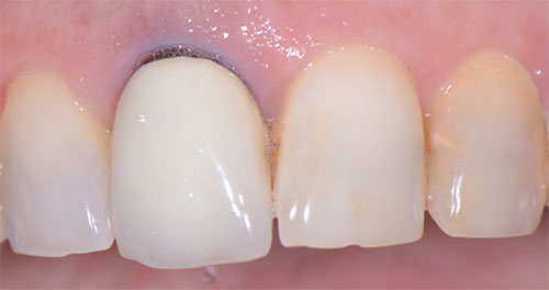 Radice scura del dente con corona e gengiva scolorita