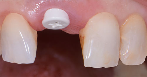 Impianto in zirconia