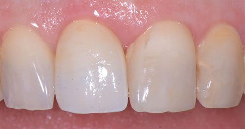 Impianto dentario in zirconia con corona e gengiva rosa