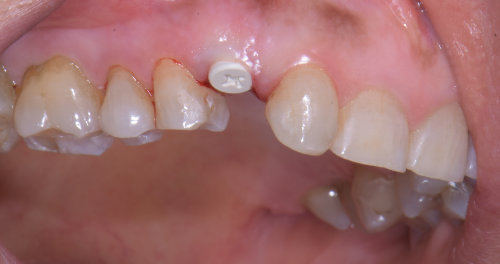 Impianto in zirconia