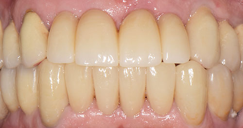 Implantat aus Zirkonkeramik